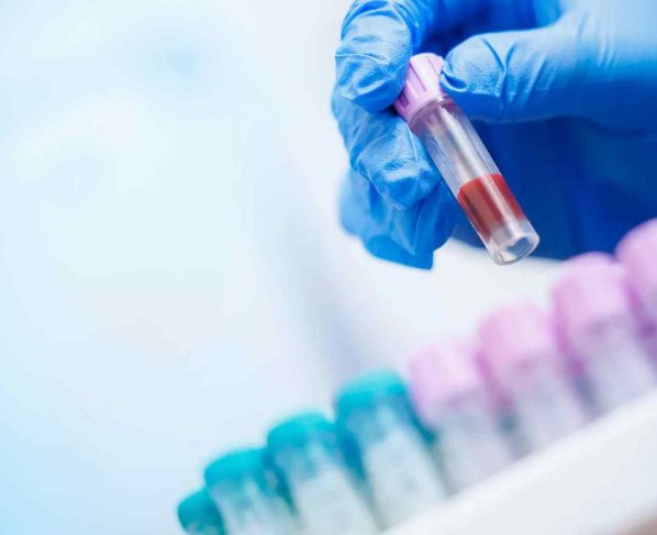 exame de sangue Alzheimer