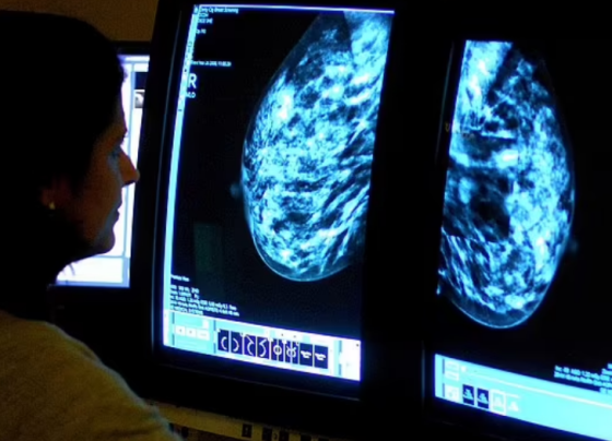 câncer de mama