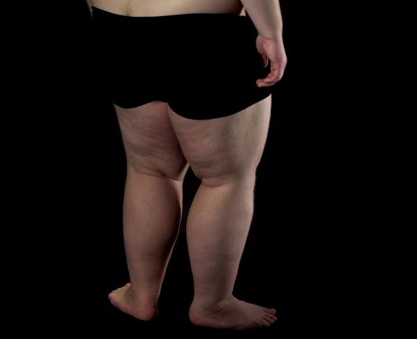 A perda de peso pode melhorar a saúde geral, mas não remove a gordura característica da doença